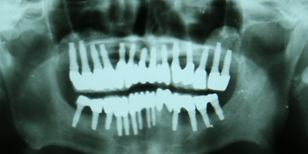 x-ray  photo during Dental Implants treatment