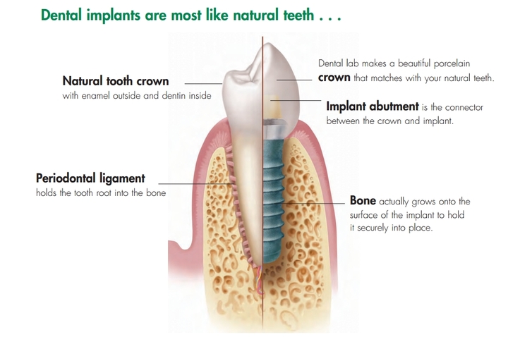 インプラントは自然歯と似通った作りになっています
