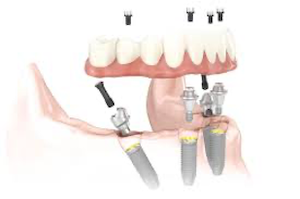 Who is a candidate for All-on 4 Dental Implants?
