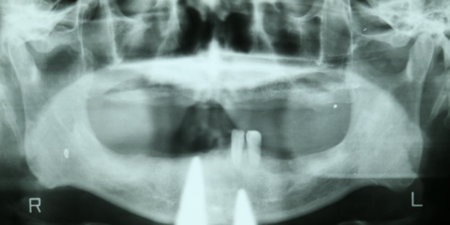x-ray  photo before  Dental Implants treatment