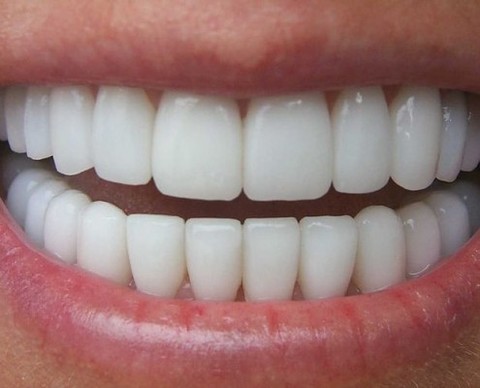 metal-free teeth