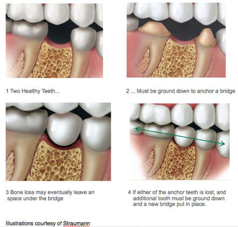 Dental Bridge