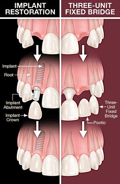 Dental Implants vs Dental Bridge