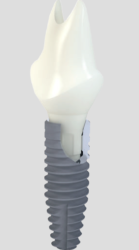 Straumann Bone Level Tapered Implant