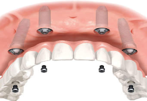 What are All- on-4 Dental Implants?