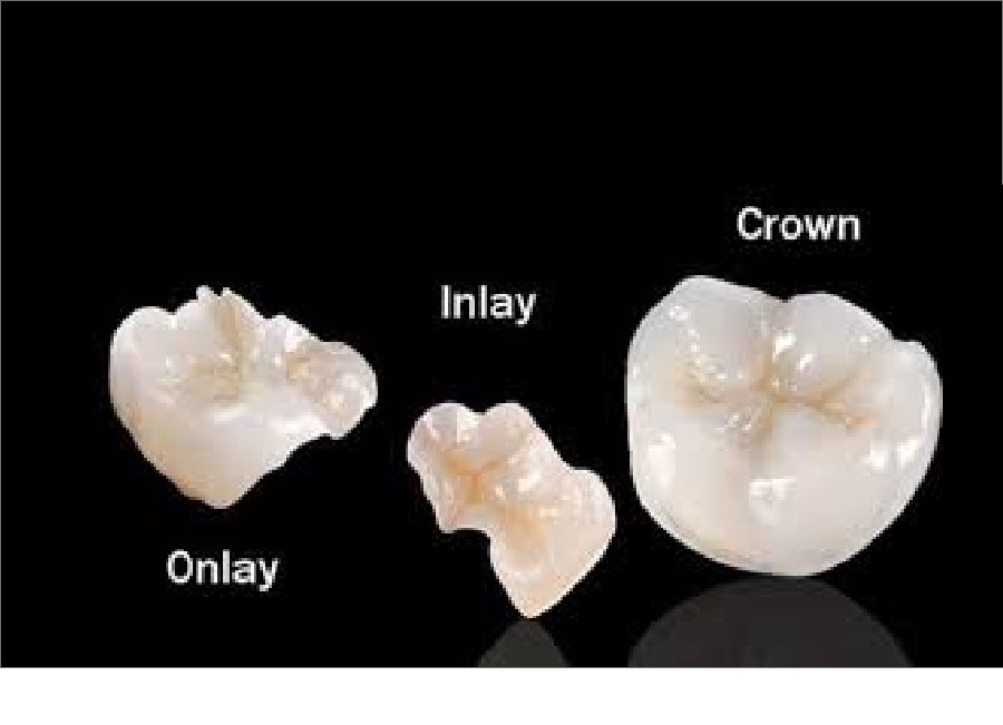 tooth-colored fillings-sample